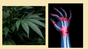 Cannabis In Arthritis Treatment